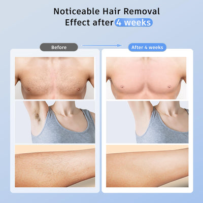 IPL Laser Hair Removal